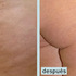 COMO ELIMINAR LA CELULITIS FACIL Y RAPIDAMENTE PARA SIEMPRE!
