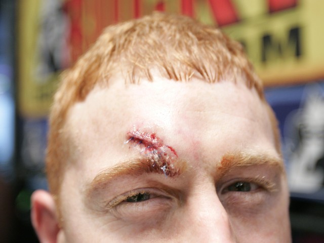 Cord McCoy sports a fresh set of stitches from a wound inflicted by a bull named Dirty Harry at the Professional Bull Riders Versus Invitational on Jan. 6, 2008.