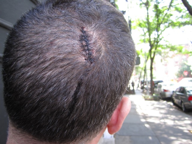 He got stitches in the back of his head, too.