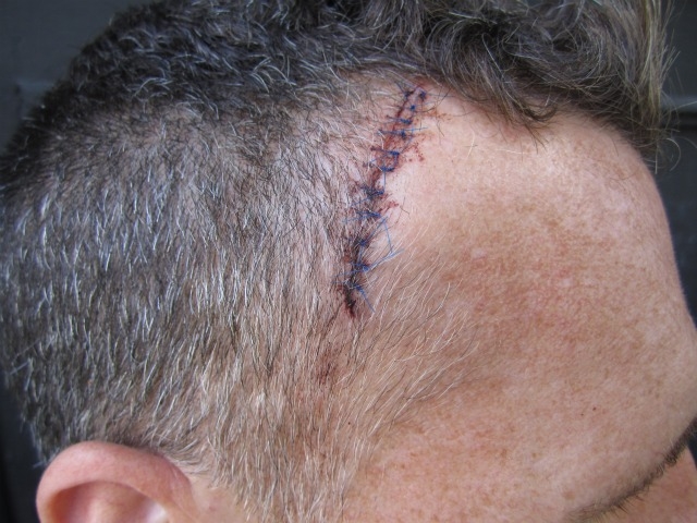 A closeup of the stitches on Ives' head.