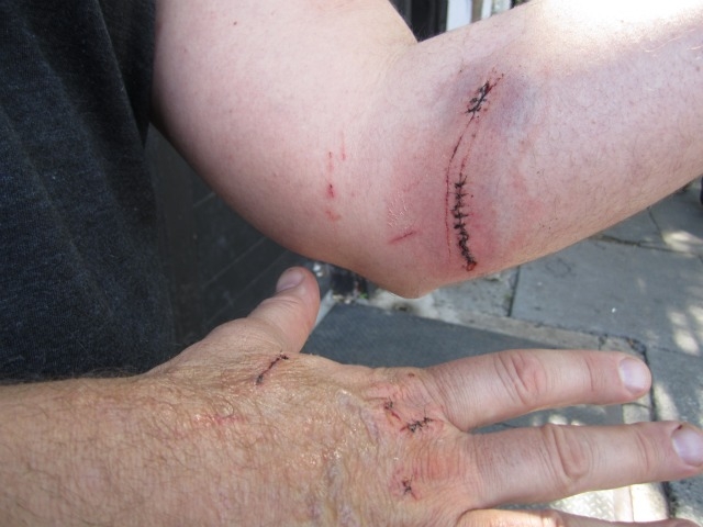 Ives had deep cuts and bruises on his arms, too.