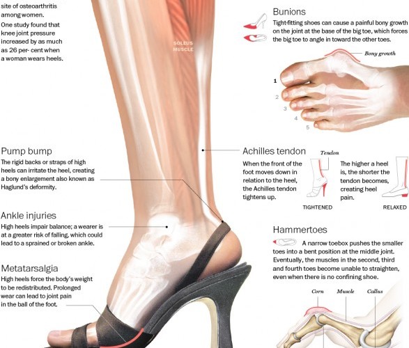 High Heels Infographic: The Damage Pumps Can Cause To Your Body