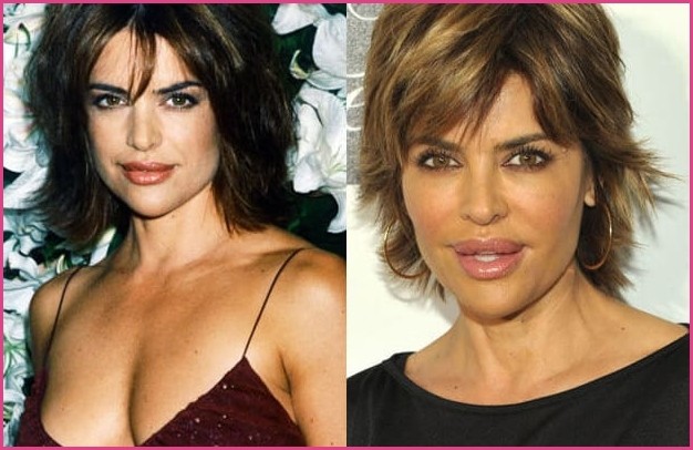 20 Celebrities That Ruined Their Faces With Cosmetic Surgeries Omg Celebrities Surgeries Cosmetic Fails R Cosmetic Surgery Laser Hair Removal Laser Hair