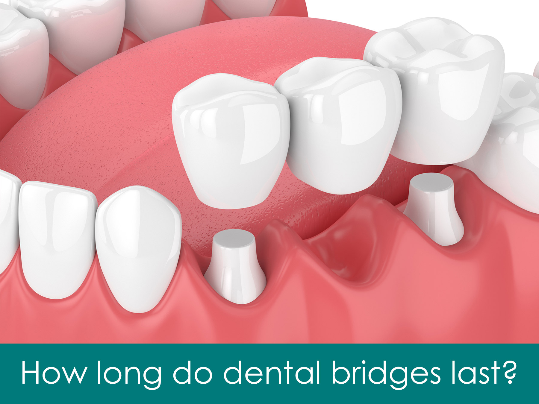 Dental bridges tend to last 510 years since they can be