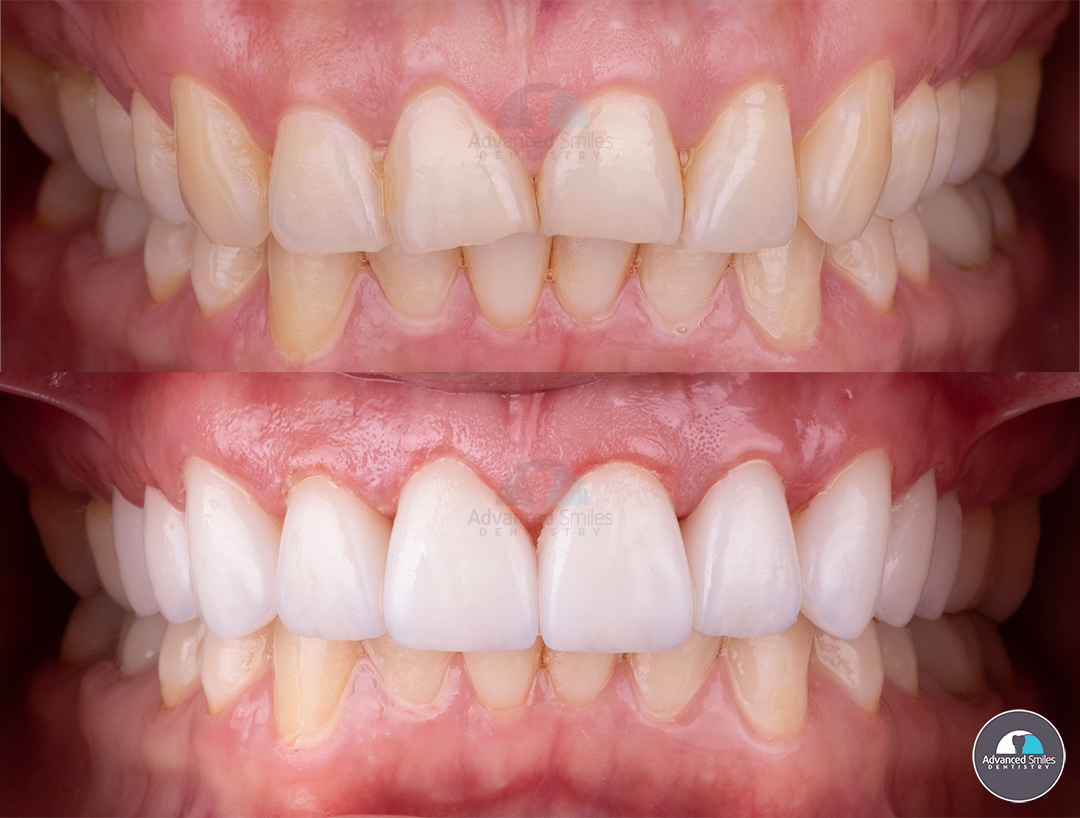 Check out this pictures just after the delivery of 10 beautiful veneers