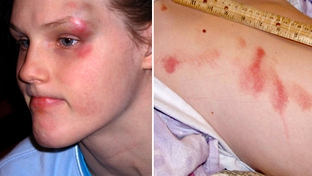 Jennifer Howson was restrained dozens of times in her Kemp public school, often sustaining injuries like these. 