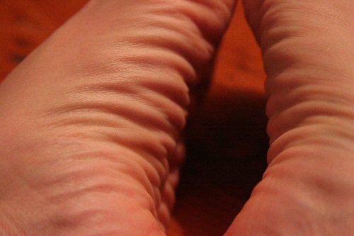 wrinkles