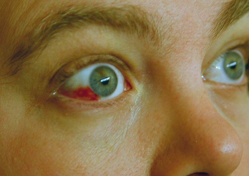 bloody eyeball
