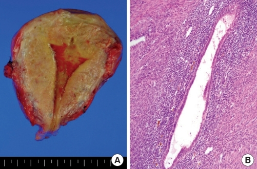Fig 1 - Pathological findings of hysterectomized uterus. (A) Gross appearance of adenomyosis. Note coarsely trabeculated, diffusely hypertrophied myometrium stippled with foci of ectopic endometrium. (B) Hematoxylin and eosin-stained section of uterus, showing endometrial glands and stroma surrounded by hypertrophied myometrium. Occasional hemosiderin-laden macrophages were also observed. Magnification, ×100.