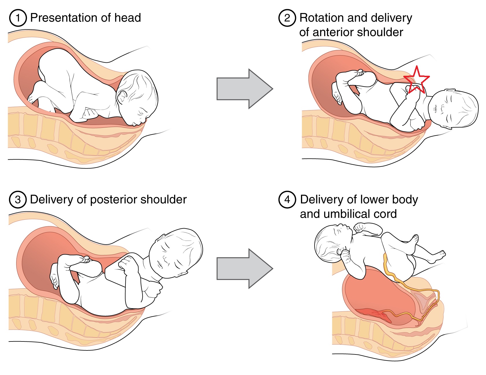 Delivery - TeachMeObGyn