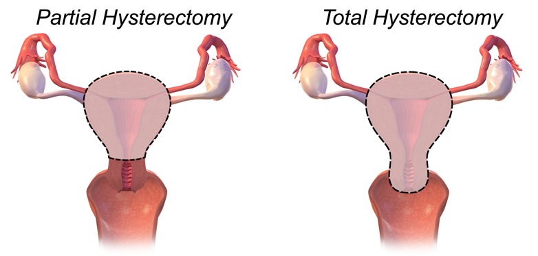 Fig 4 - Partial (subtotal) and total hysterectomy.