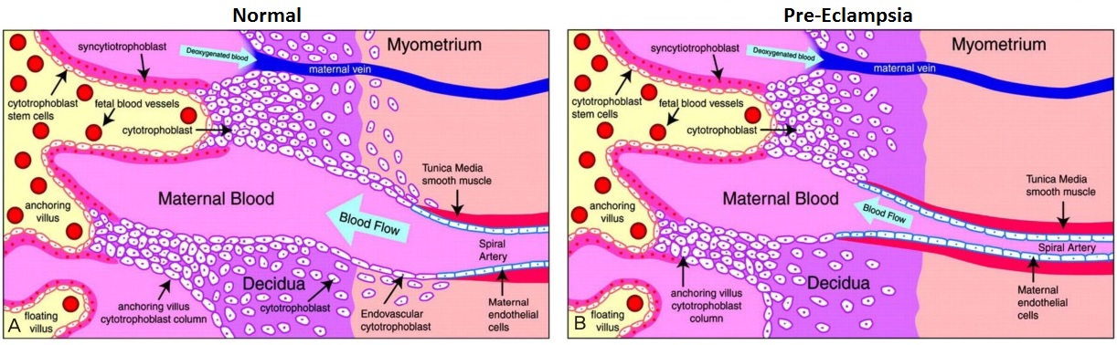 Fig 1 - The spiral arteries in pre-eclampsia are thought to produce a high-resistance, low flow circulation.