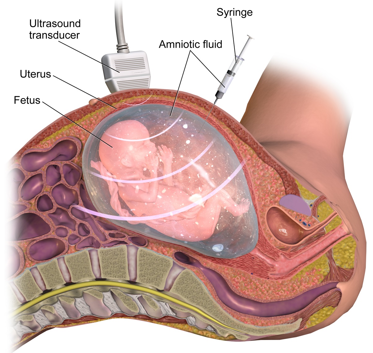 Fig 1 - Amniocentesis, used to sample amniotic fluid