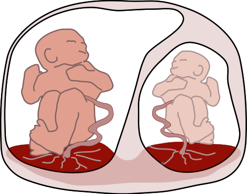 Fig 2 - Twin to twin transfusion syndrome, a complication of a disproportionate blood supply in twin pregnancies. It is a cause of polyhydramnios.