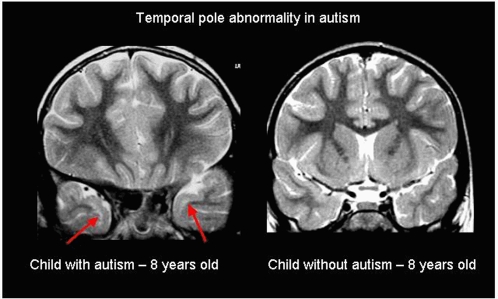 Fig 1 - Structural abnormalities have been demonstrated in those with autism, but it is unclear how this produces the features of the disorder.