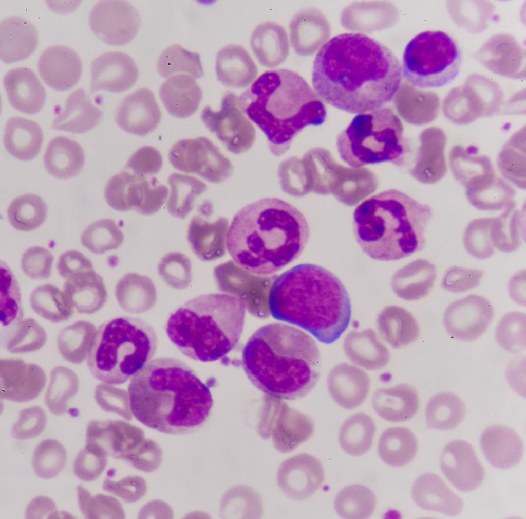 Leukaemia Pathophysiology Management TeachMePaediatrics