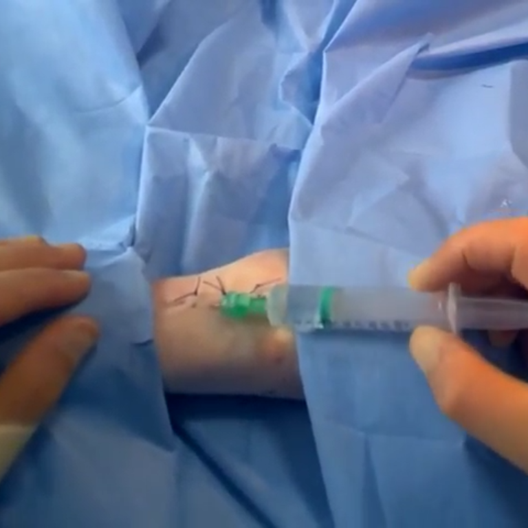 Infiltration of Local Anaesthetic TeachMeSurgery