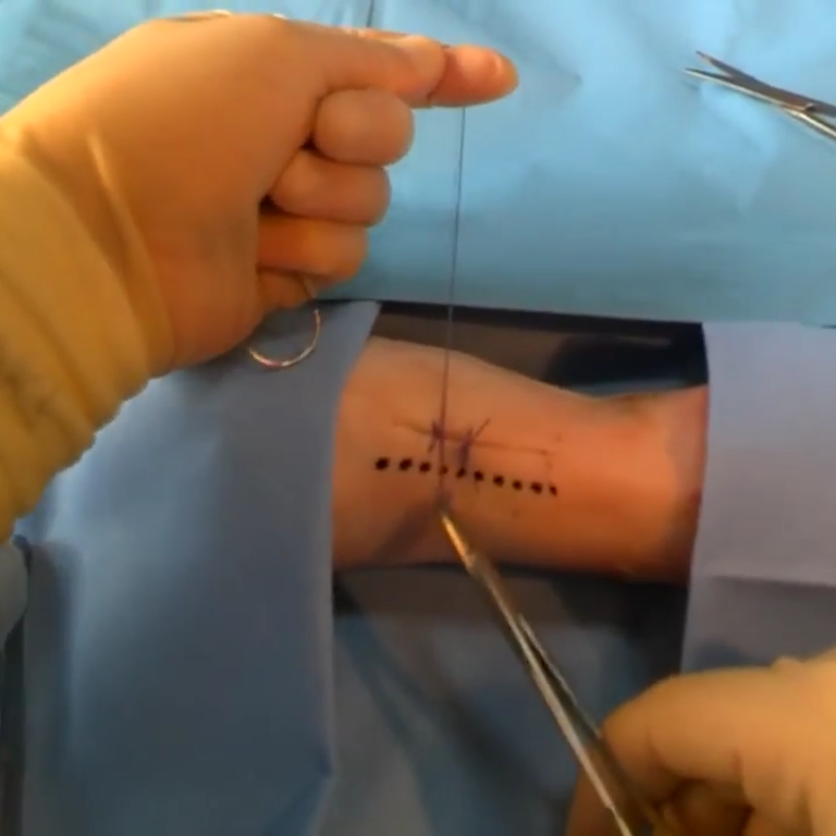 Anal dvt stitches pics 191