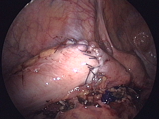 Fig 1 - Anastamosis of the sigmoid colon, following bowel resection secondary to diverticular disease.