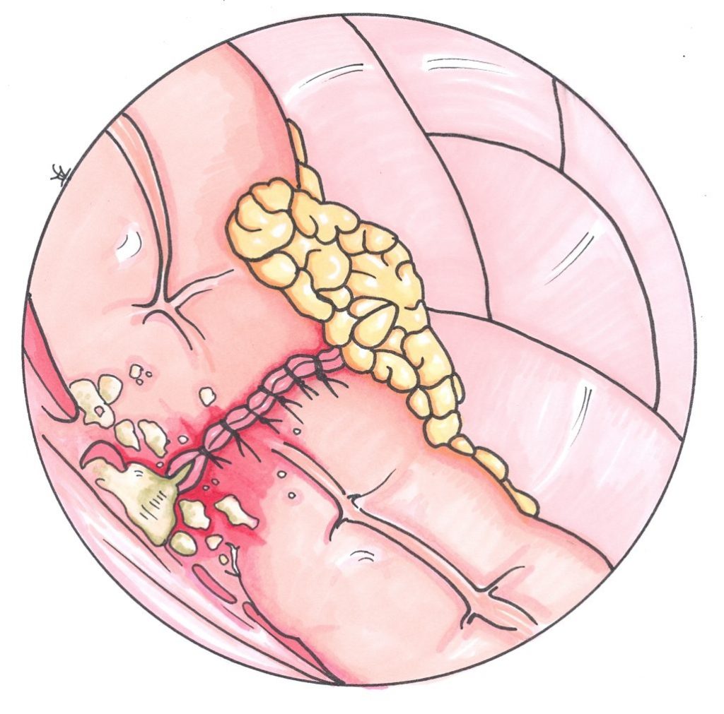 breast cancer leaky incisions Hard homo fuck