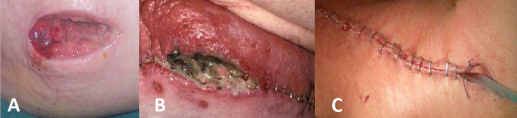 Fig 1 - (A) Purulent discharging forming in open wound; (B) Erythema and pus seen in closed wound; (C) drain placed in situ to remove any potentially accumulating pus.