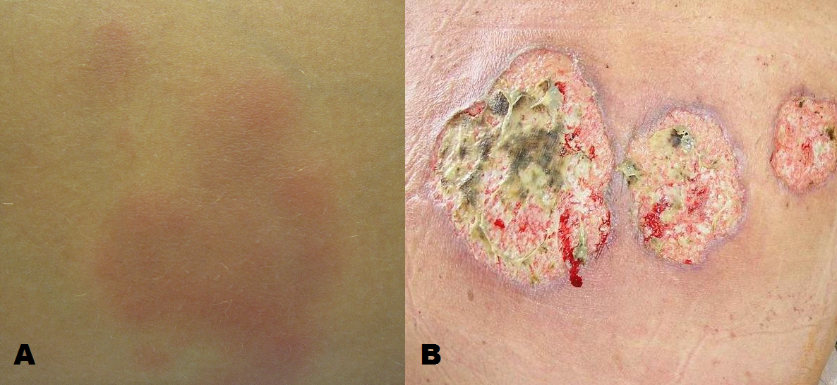 Fig 2 - Extra-intestinal manifestation of Crohn's disease: (A) Erythema nodosum (B) Pyoderma gangrenosum