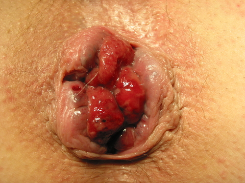 Fig 1 - Haemorrhoids located in the 3, 7, and 11 o'clock positions