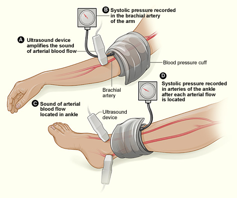 chronic limb ischaemia clinical