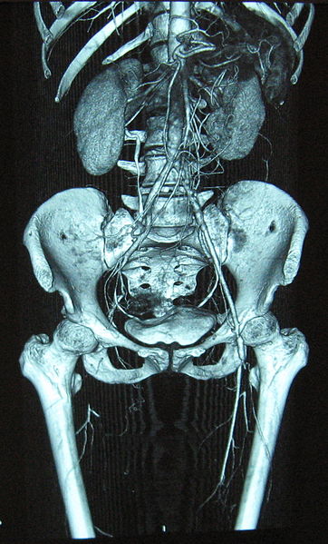 Fig 2 - Reconstructed 3D CT angiogram, showing complete occlusion of the right femoral artery.