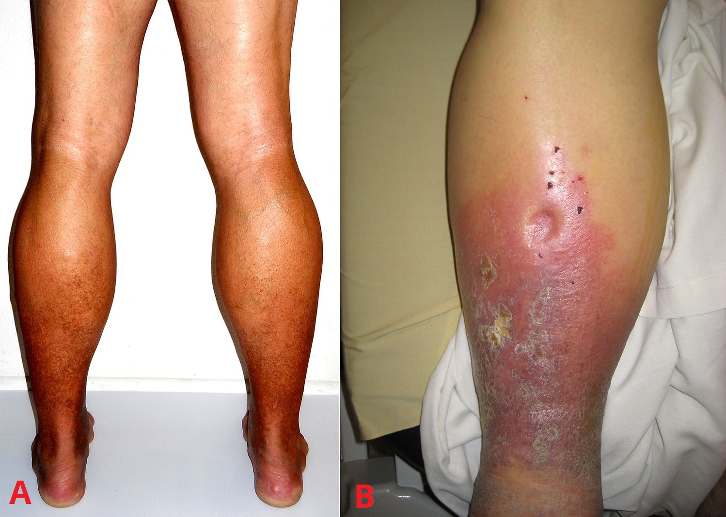 varicose veins lower leg varicose veins lower leg