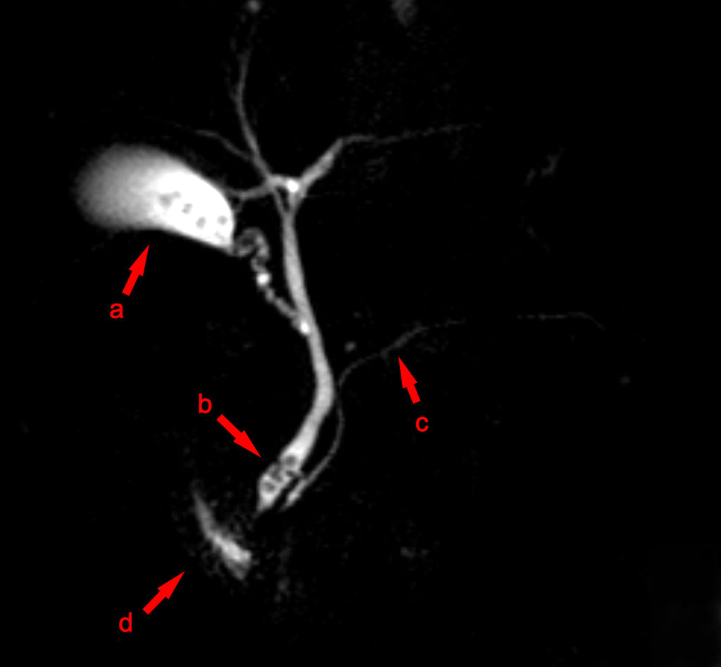 Fig 3 - MRCP image showing stones in the distal common bile duct: (a) Gallbladder with stones (b) Stone in bile duct (c) Pancreatic duct (d) Duodenum.