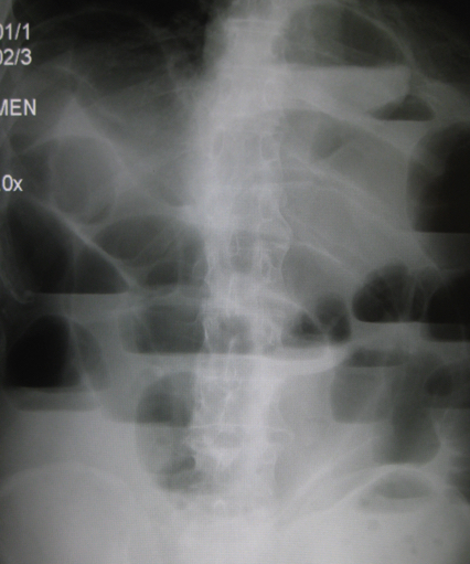 Fig 2 - Small Bowel Obstruction, as seen on AXR, caused by bowel adhesions