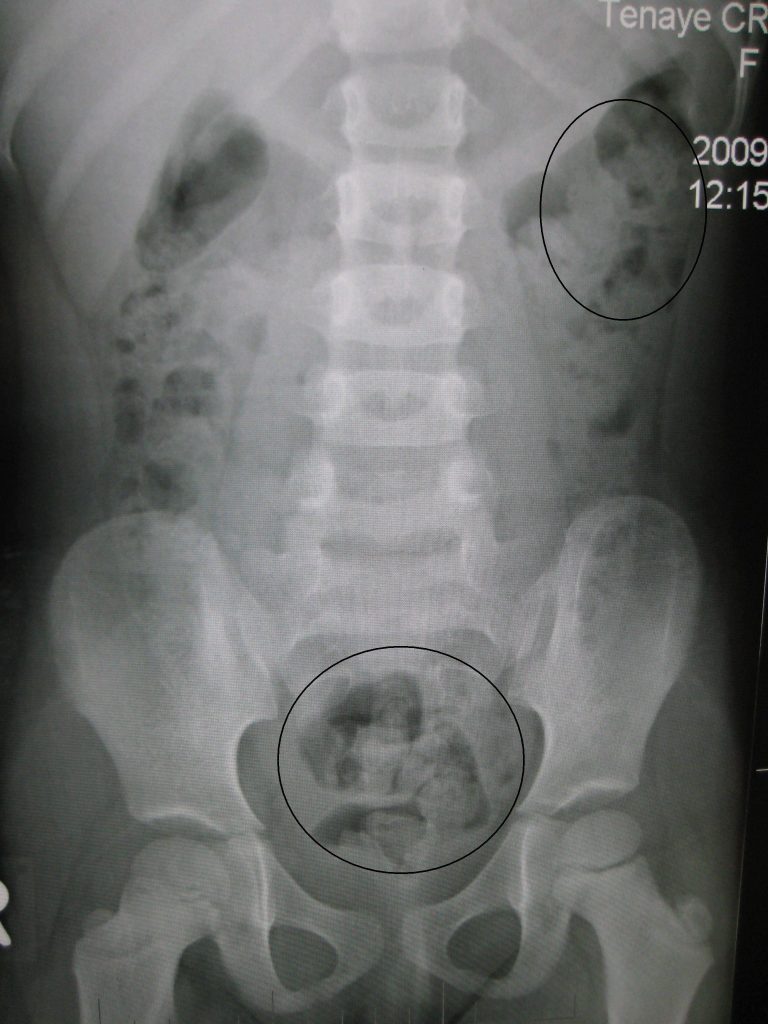 Fig 2 - X-ray image of constipation in a child. The faecal matter is opaque white, surrounded by black bowel gas.
