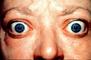 Fig 2 - Proptosis and lid retraction in thyroid eye disease.