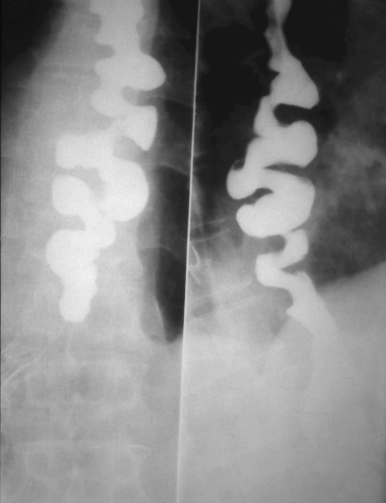 Fig. 4 - A Barium swallow performed in a patient with diffuse oesophageal spasm. A corkscrew appearance is observed.
