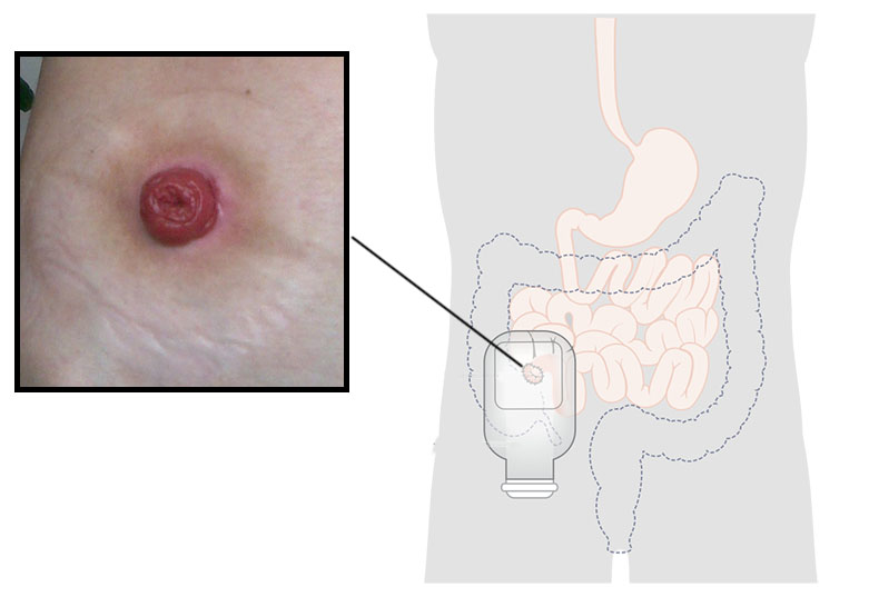 Fig 2 - An ileostomy is situated on the right side of the abdomen, and has a spouted opening.