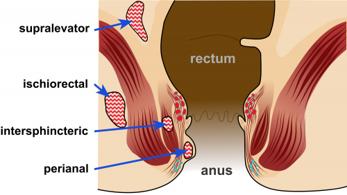 Fig 1 - Classification of anorectal abscess by location.