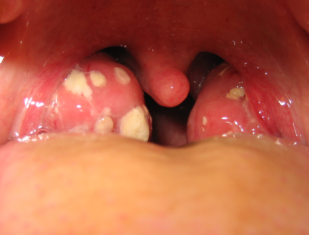 How to treat purulent quinsy in a child How to treat purulent quinsy in a child