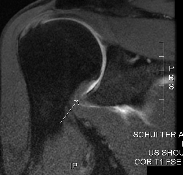 Adhesive Capsulitis Frozen Shoulder Management TeachMeSurgery