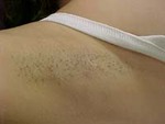 Tn-underarm-hair-removal