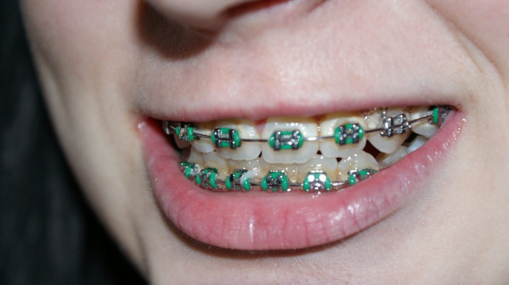 Harmful Effects Easter Candy Can Have on Braces DelmarvaLife