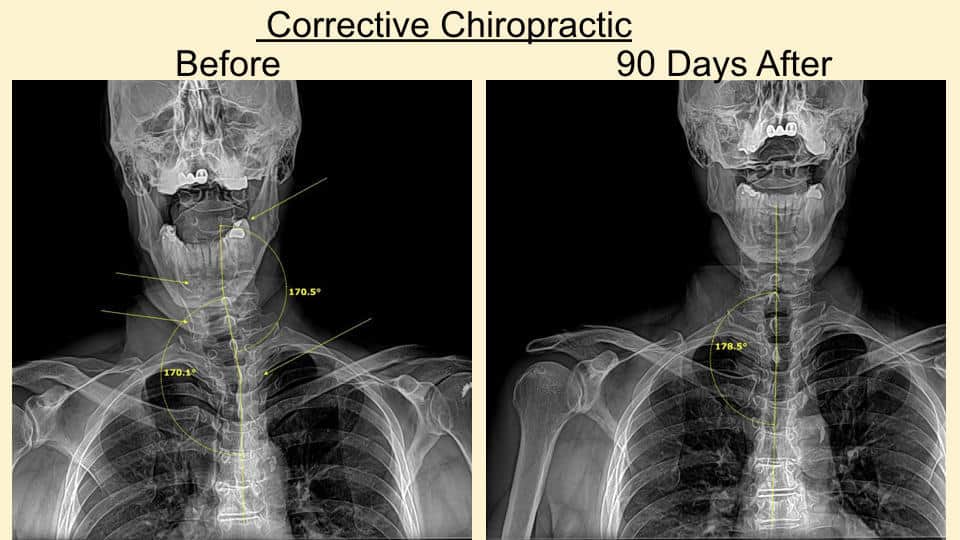 Why you need a chiropractor Dr. John Bergman
