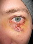Blackeye