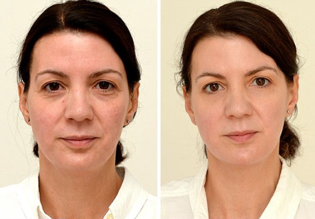 antes e depois skincare coreano