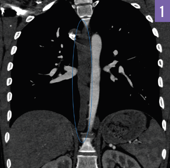 Coronal view CT scan