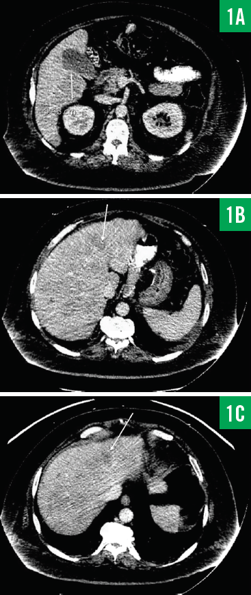 CT scans figures 1a b c