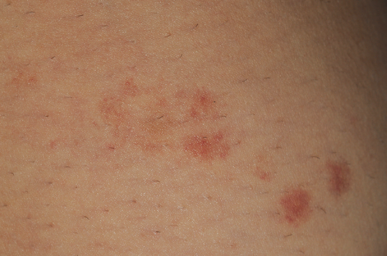 benign pigmented purpura