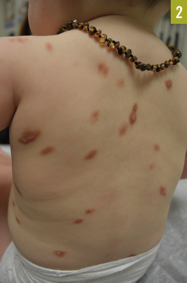 urticaria