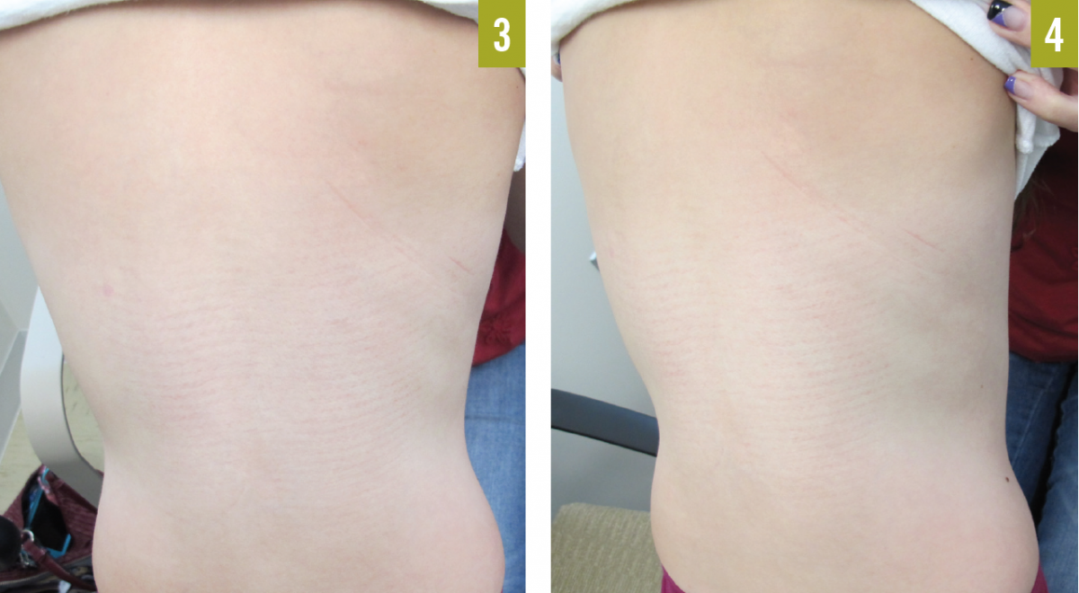 psoriasis outcome