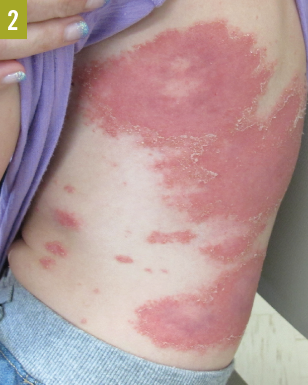psoriasis